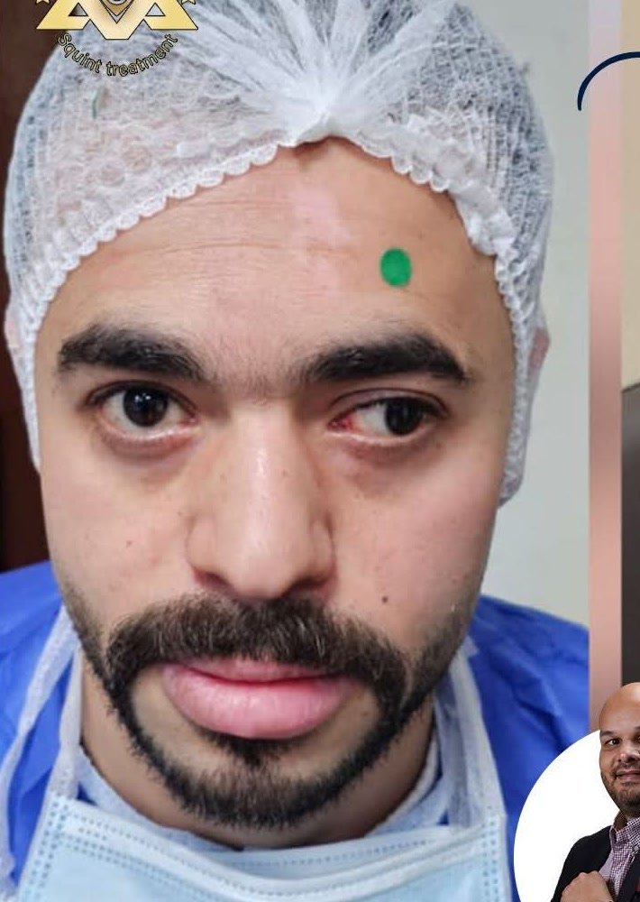 انحراف محور العين قبل التدخل الجراحي